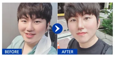 [Gangnam Unni] Nâng mũi / Tháng thứ 5 / Biệt danh: Bonjuronam