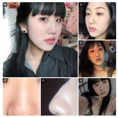 [Babytalk] Nâng mũi / Sau 1 tháng / Biệt danh: Kim Min-ji 1111