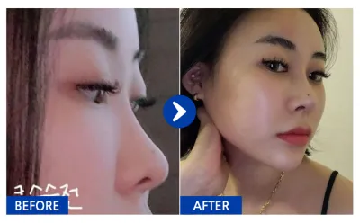 [Babytalk] Phẫu thuật mũi / Tháng thứ 2 / Biệt danh: Kkot-syu-ni-i