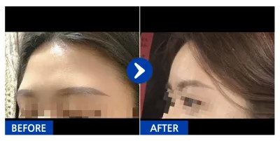 [Gangnam Unni] Cấy mỡ / Tháng thứ 2 / Biệt danh: 영ㅇ0