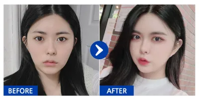 [Babitalk] Cấy mỡ, gọt mặt, cắt mí / Tháng thứ 3 / Biệt danh: Woo-ah-eo-ah-ah-ah