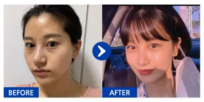 [Babitalk] Cấy mỡ / Tháng thứ 5 / Biệt danh: Amelicano