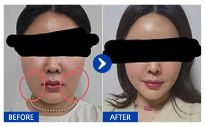 [Gangnam Unni] Hút mỡ / Tháng thứ 2 / Biệt danh: Kkobugi