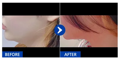 [Gangnam Unni] Hút mỡ / Biệt danh: BYJ72