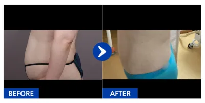 [Babitalk] Hút mỡ / Tháng thứ 1 / Biệt danh: 꽃다운그자