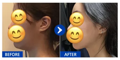 [Babitalk] Hút mỡ mặt / Sau 1 tháng / Biệt danh: Babitok-hi