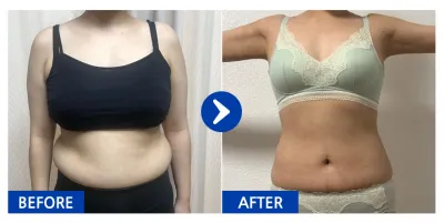 [Babitalk] Hút mỡ bụng, bắp tay / Tháng thứ 5 / Biệt danh: Đừng ăn đó là vị mình đã biết