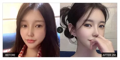 [Review Gangnam Unni] Chỉnh hình sụp mí, tái phẫu thuật mắt sau một tháng / Biệt danh: wingit