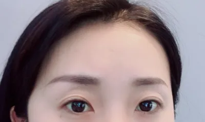 [Mắt] Kim Jung Kim Jeom - Mở rộng góc mắt ngoài, hạ góc mắt