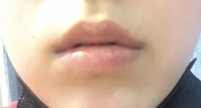 [Tiểu phẫu] Mũm mĩm 짜으릉 - Filler