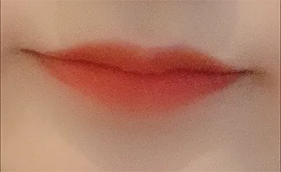 [Tiêm filler] Donggolla - Môi