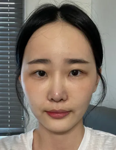 [Mắt] Tiểu phẫu - Cắt mí mắt hai mí (phương pháp chôn chỉ), mở góc mắt trong, hạ góc mắt ngoài