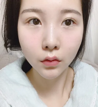 [Mắt] Mùa đông - Cắt mí (tái phẫu thuật), Mở góc mắt trước (tái phẫu thuật), Hạ góc mắt dưới