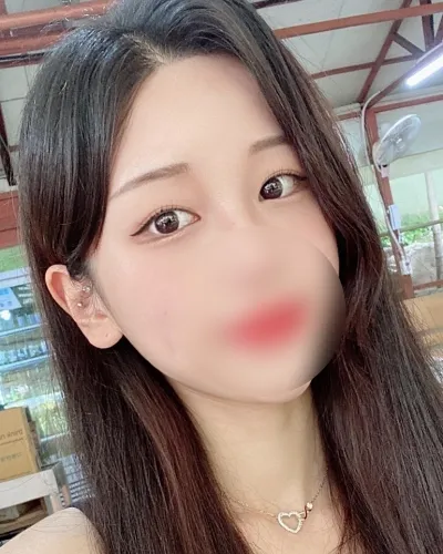 [Mắt] Turigusul - Cắt mí (tái phẫu thuật), mở góc dưới mắt