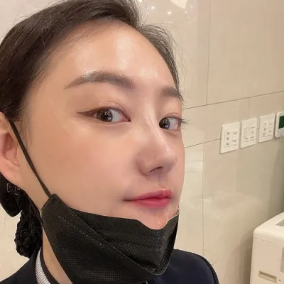 [Mũi] Ngân Hà - Nâng sống mũi, thu nhỏ đầu mũi, gọt xương mũi gồ