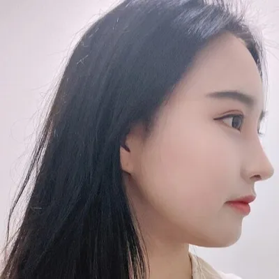 [Mũi] Thích mùa đông - Gọt xương sống mũi và đầu mũi