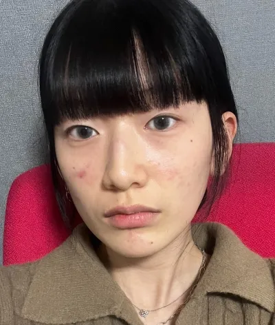 [Mắt] Dew - Chỉnh sửa mí mắt không phẫu thuật