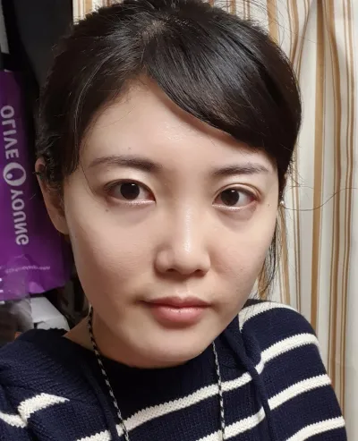 [Mắt] Đánh giá tích cực - Tái phẫu thuật cắt mí