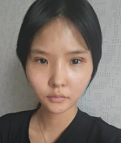 [Mắt] Minchodan - Tái phẫu thuật cắt mí mắt, mở góc mắt trước, mở góc mắt sau, hạ góc mắt