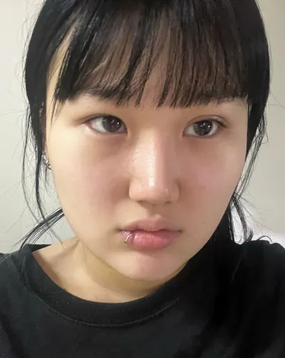 [Mắt] Grey Banana - Tái phẫu thuật cắt mí, mở góc mắt trước