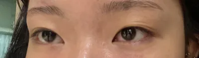 [Mắt] Cocoa - Cắt mí và mở góc mắt trong