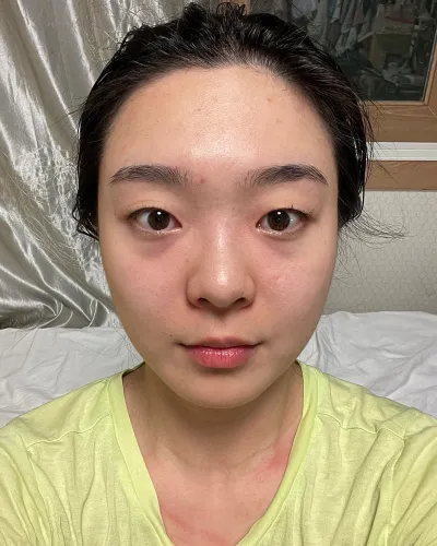 [Mắt] Panpanda - Tái định vị bọng mỡ dưới mắt