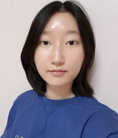 [Mắt] Trứng cuộn - Tái phẫu thuật chỉnh sửa mí mắt cắt mí, mở góc mắt dưới