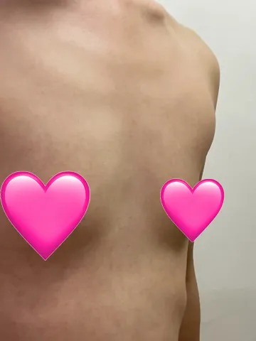 [Ngực] Nemo Beam - Ngực