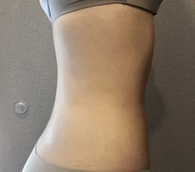 [Hút mỡ] Bay cao như những vì sao - Hút mỡ bụng, bắp chân