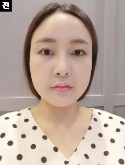 [Tiểu phẫu] Hyun Bbo Jju - Ultherapy, Botox tạo đường nét