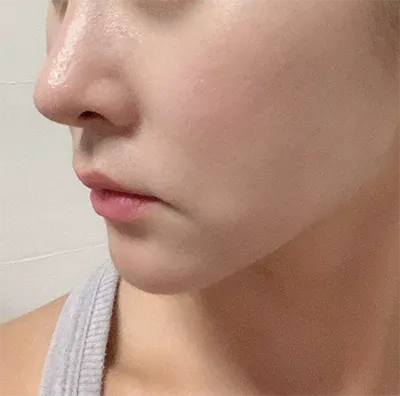 [Tiểu phẫu] kiya*** - Nâng cơ