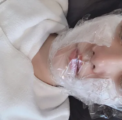 [Tiểu phẫu] Kkusam - Ultherapy