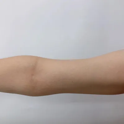 [Hút mỡ] Mùa hè nóng bỏng - Tiêm tan mỡ cánh tay