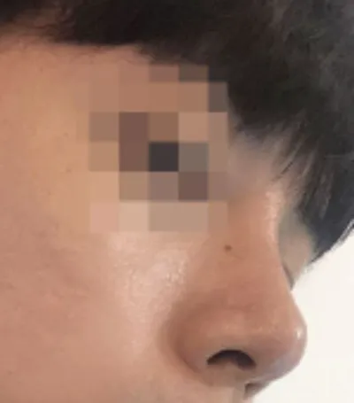 [Mũi] Koz802 - Sống mũi