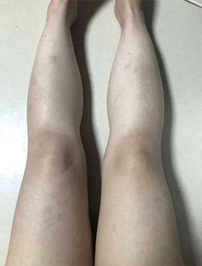 [Hút mỡ] zz0808 - Hút mỡ