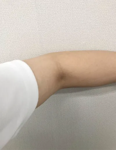 [Tiêm thẩm mỹ] Nóng quá - Bắp tay