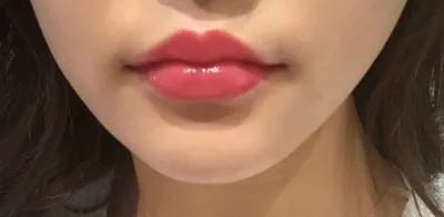 [Tiêm filler thẩm mỹ] AmorMi - Filler