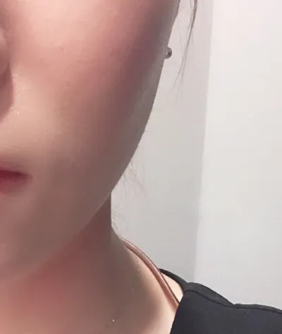 [Da] sang13 - Ultherapy