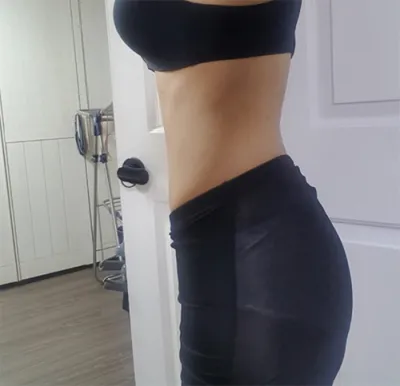 [Hút mỡ] Juvederm - Hút mỡ (bụng)