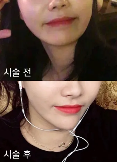 [Tiểu phẫu] Yalla Shongss - Tiêm filler cằm