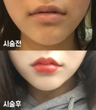 [Tiêm filler] bobommm - Tiêm filler môi