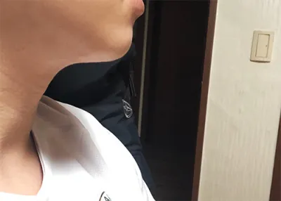 [Da] Bệnh viện G - Nâng cơ bằng Shurink