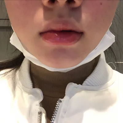 [Tiểu phẫu] Kkyukkyangpang - Tiêm filler môi