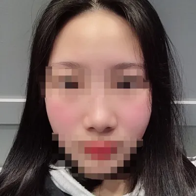 [Tiểu phẫu] Hyokong2 - Filler, Botox