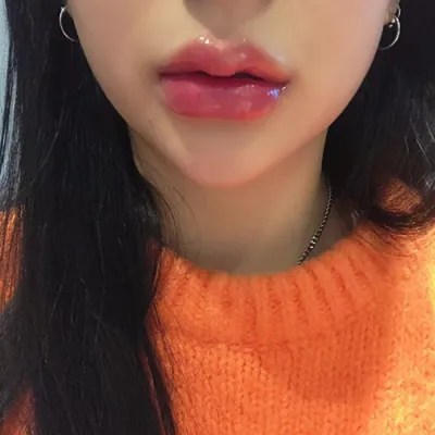 [Tiêm filler] naaa_ - Filler