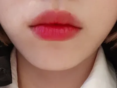 [Tiểu phẫu] Dearupa - Filler, Botox