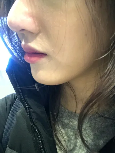 [Tiểu phẫu] si123 - Tiêm thu gọn cánh mũi