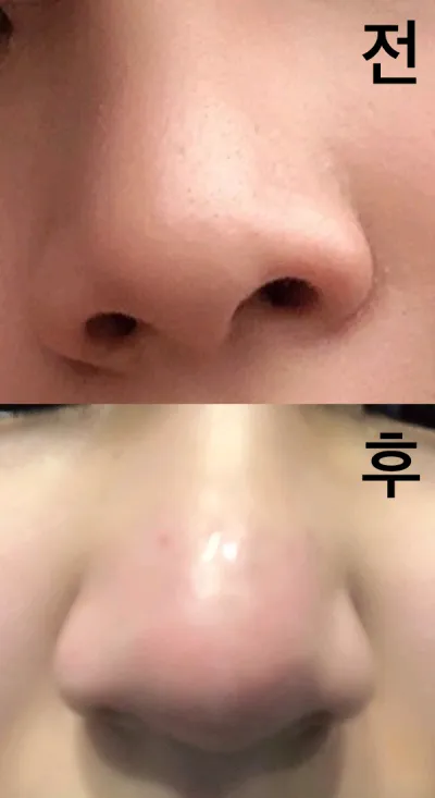 [Tiêm thẩm mỹ] Môi - Tiêm tan mỡ tạo hình mũi