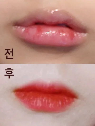 [Tiêm thẩm mỹ] Môi - Filler, Botox