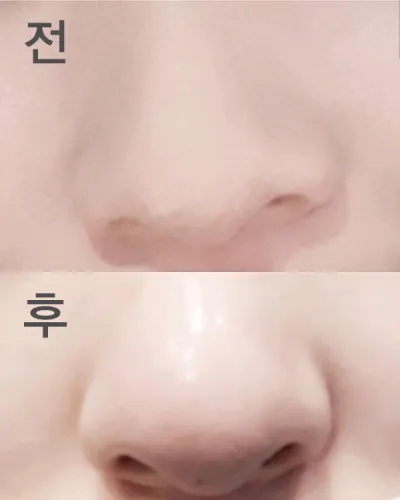 [Tiêm thẩm mỹ] Pru - Tiêm tạo hình mũi